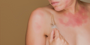 Rodzaje alergii - jak je rozpoznać - tlo